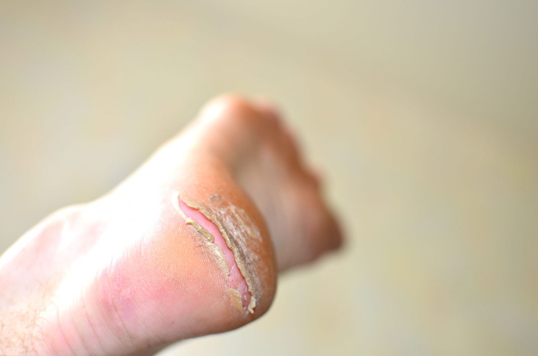 På bilden är höger fot häl med torrhet och sprickor.