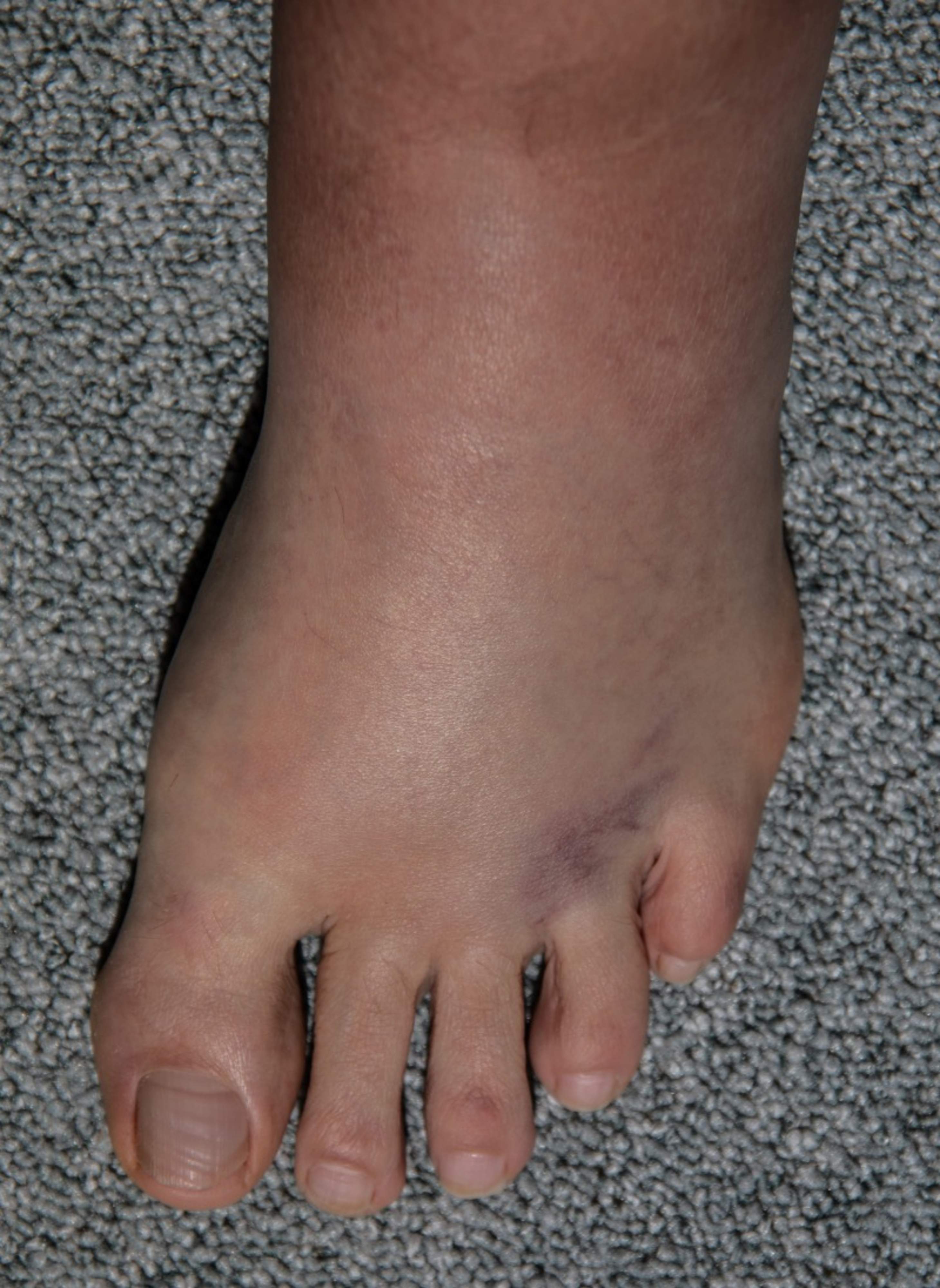 Picture of a foot that is reddish-mottled, swollen, and somewhat structurally altered. The foot is classified as risk category two.