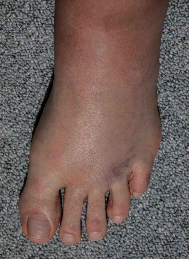 Bilden av foten, som är rödfärgad, svullen och till sin struktur i viss mån förändrad. Foten klassificeras som riskklass två.