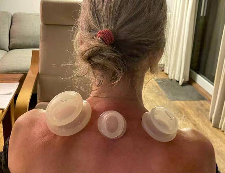Person ses bagfra med håret samlet op, mens tre gennemsigtige cupping-kopper sidder på øvre ryg og nakke i et hjemmemiljø.