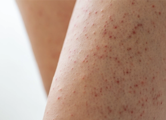 Närbild av hud på ben med många små röda knottror och ojämn hudstruktur, vilket synliggör hudens yta i detalj inom kroppsvård och skincare.