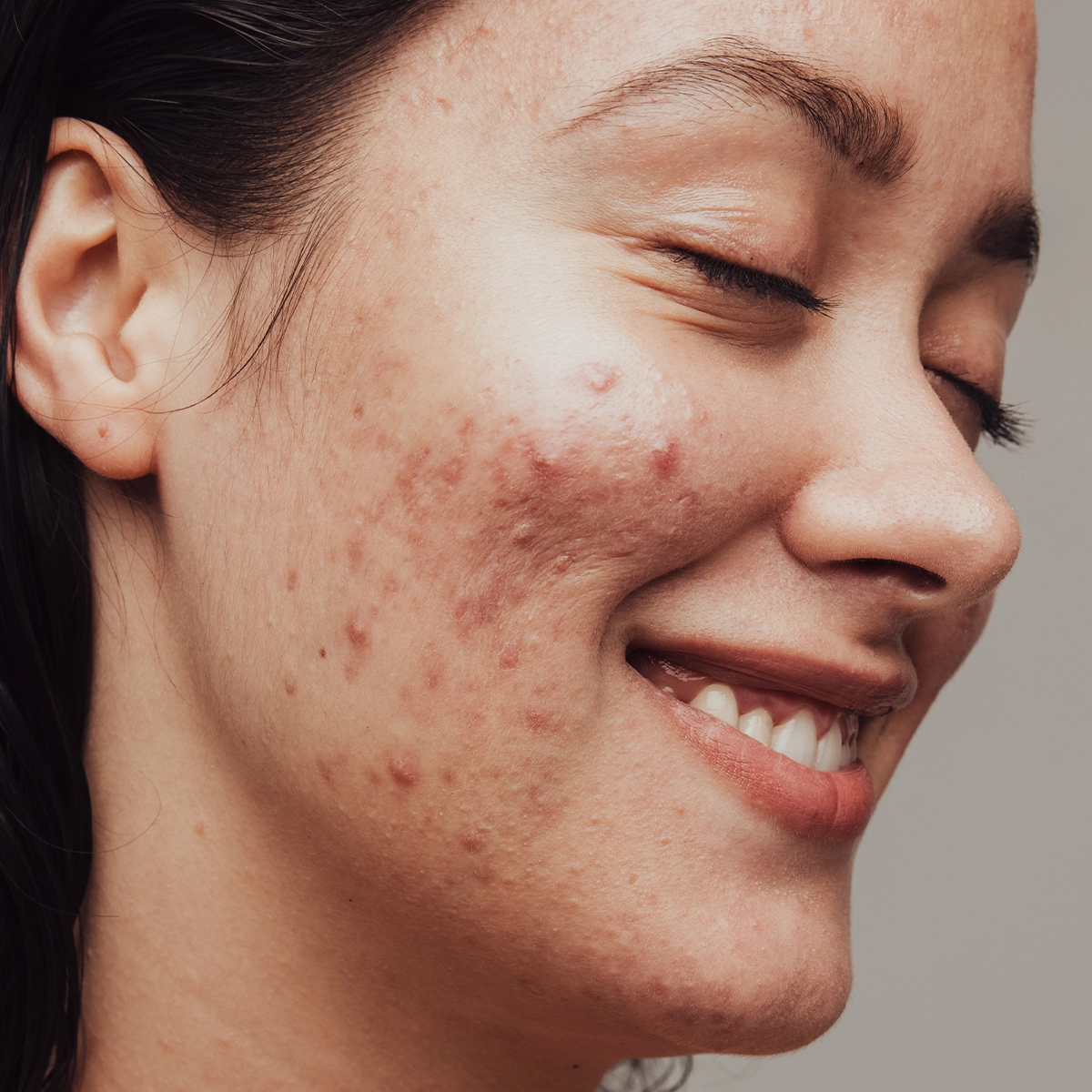 Närbild av en persons ansikte i profil där kinden, näsan och munnen syns. Huden på kinden har synliga röda märken och ojämn struktur. Personen ler lätt och har mörkt hår som faller bakom örat. Bakgrunden är neutral och enfärgad.