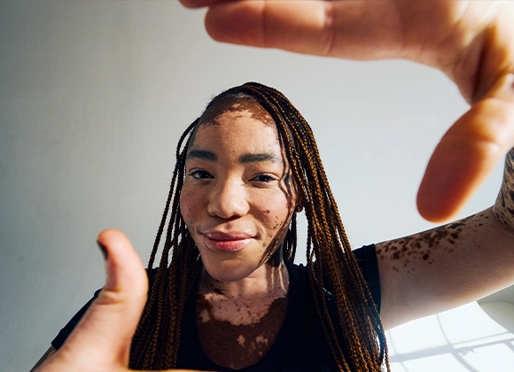 En person med långt flätat hår och vitiligo håller upp händerna.