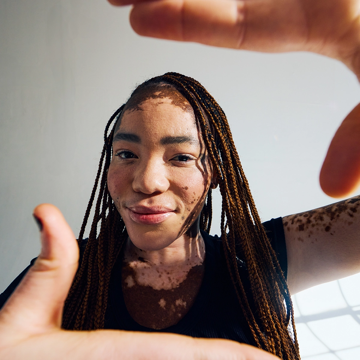 Henkilö, jolla on pitkät letitetyt hiukset ja vitiligo, pitää käsiään ylhäällä.