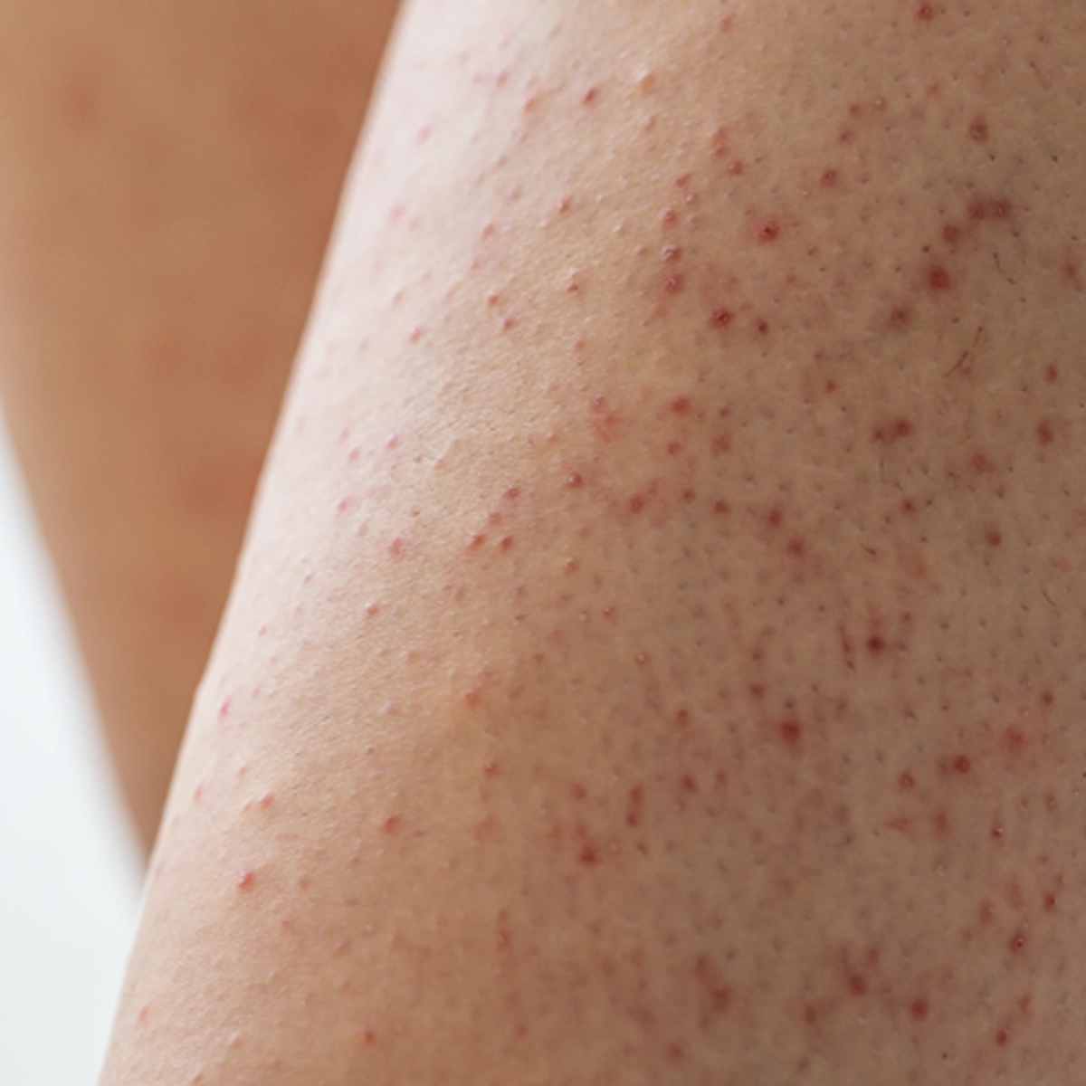 Närbild av hud på ben med många små röda knottror och ojämn hudstruktur, vilket synliggör hudens yta i detalj inom kroppsvård och skincare.