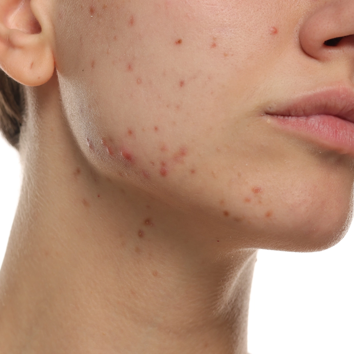 Närbild av kind, käklinje och hals på en person med synliga röda prickar och ojämn hudstruktur, fotograferad mot ljus bakgrund.