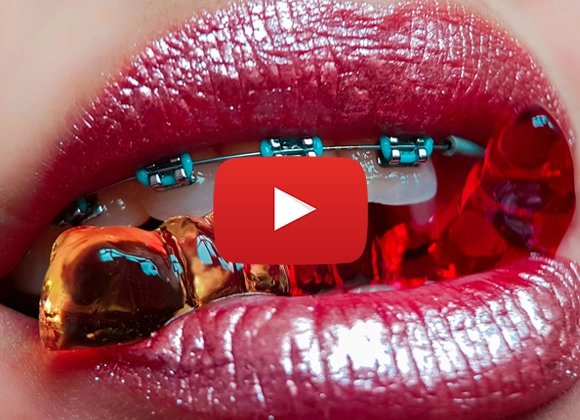 Mun med synliga tänder med tandställning och en gelégodis i munnen